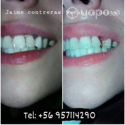 Prótesis dentales en laboratorio y a domicilio