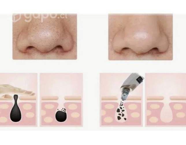 Extractor de puntos negros (comedones)