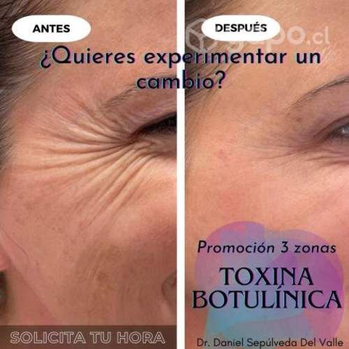 Botox 3 zonas