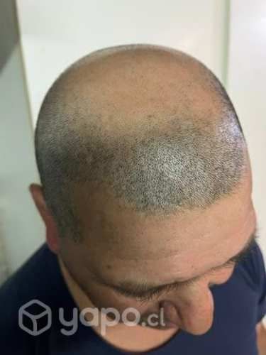 MicroScalp Micropigmentación Capilar