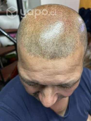 MicroScalp Micropigmentación Capilar
