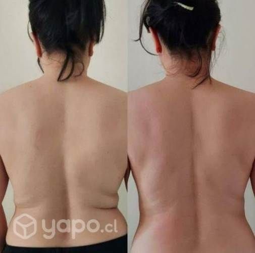 Tratamiento para Reducir Adiposidad en espalda
