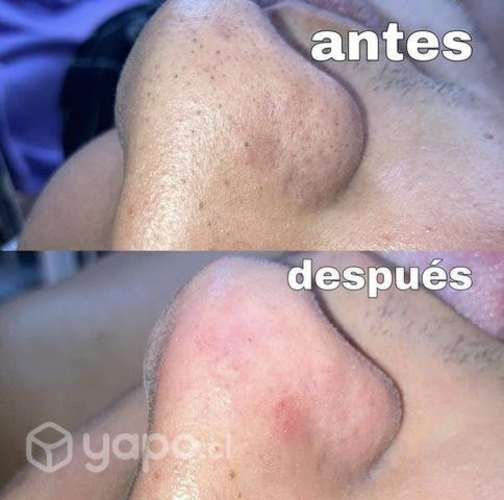 Limpiezas faciales y tratamientos