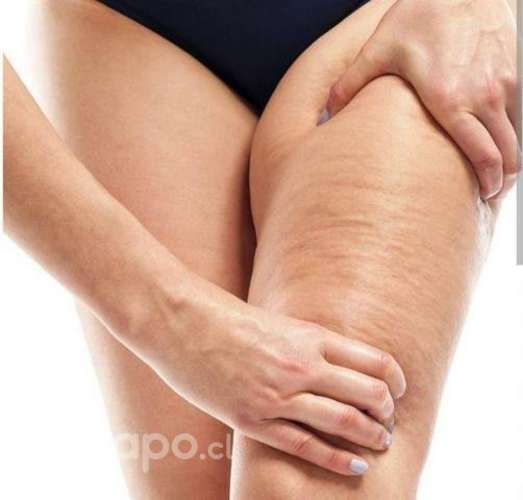 Tratamiento Anticelulítico en piernas a Domicilio