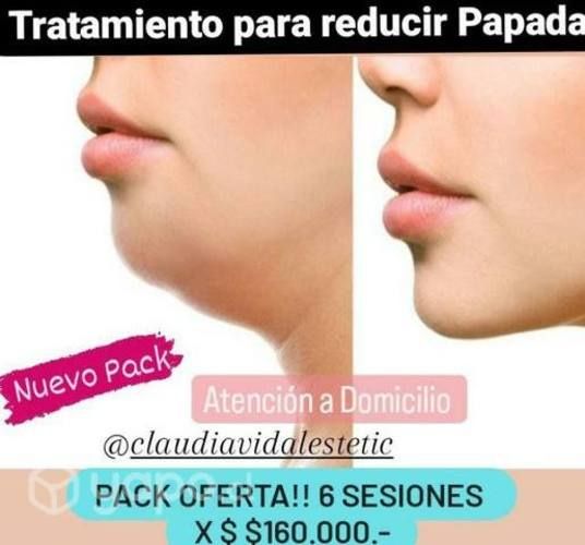 Tratamiento para reducir papada a Domicilio