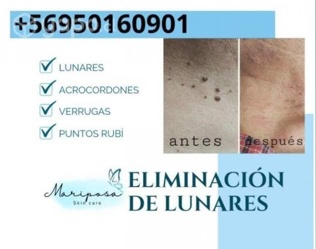 Acrocordones, lunares etc..