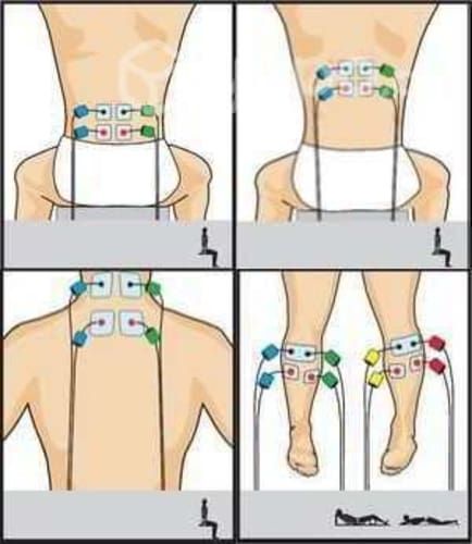Electrodos Repuesto Electrofisico Repuesto 30 Unid