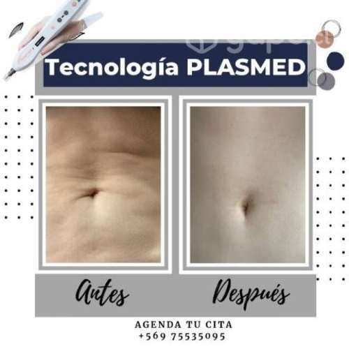 Elimina flacidez, estrías y celulitis