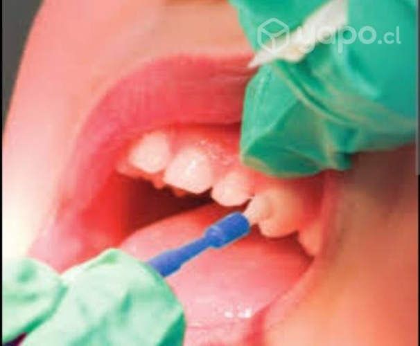 Aplicacion de fluor barniz niños y adultos