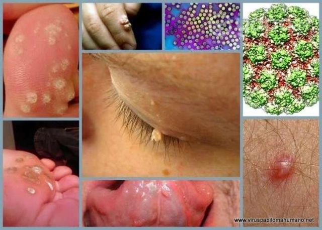 Crema elimina verrugas ,Lunares