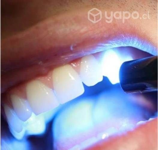 Pack 4 resinas (tapaduras blancas) + limpieza