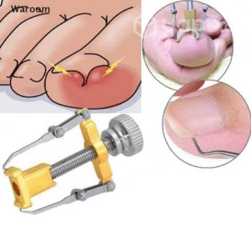 Dispositivo Para Corrección De Uñas Encarnadas