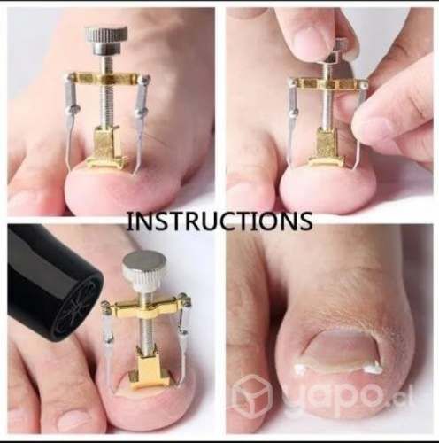 Dispositivo Para Corrección De Uñas Encarnadas