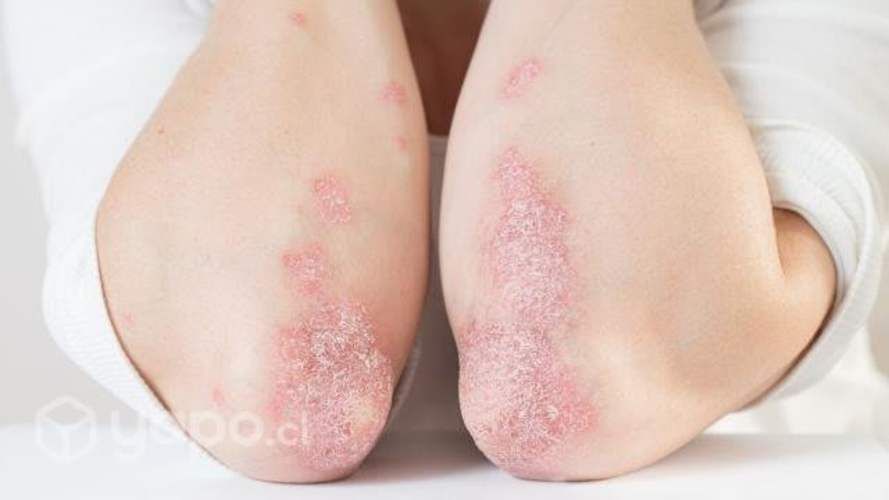 Crema para la psoriasis