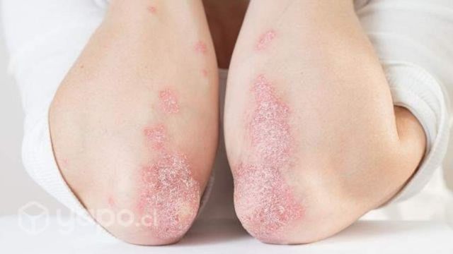 Crema para la psoriasis