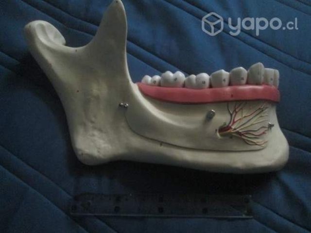 Media mandibula desmontable