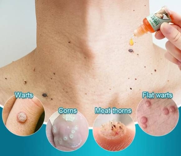 Crema Elimina Verrugas, Herpes Genital, Vulva, Condyloma