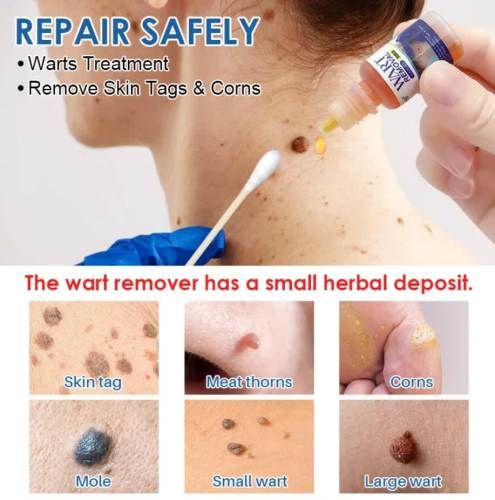 Crema Elimina Verrugas, Herpes Genital, Vulva, Condyloma