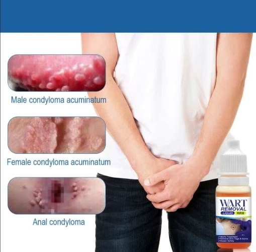 Crema Elimina Verrugas, Herpes Genital, Vulva, Condyloma